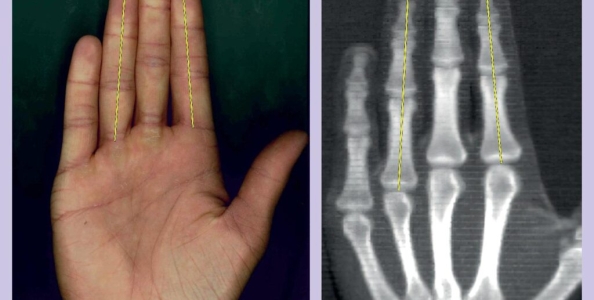 Quanto sei fortunato? Per uno studio del British Medical Journal c’è una relazione con le tue mani