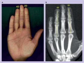 Quanto sei fortunato? Per uno studio del British Medical Journal c’è una relazione con le tue mani
